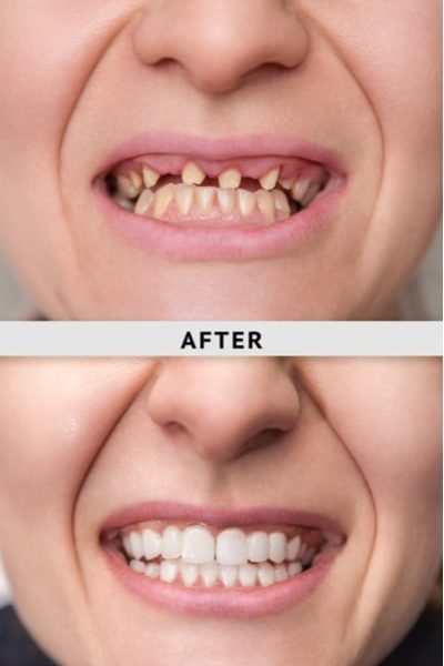 dental veneers (1)